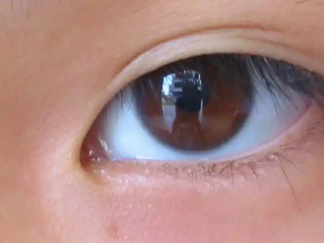 人的白睛(球结膜)上可见隐约纵横交错的络脉,正常人的络脉纤细而不