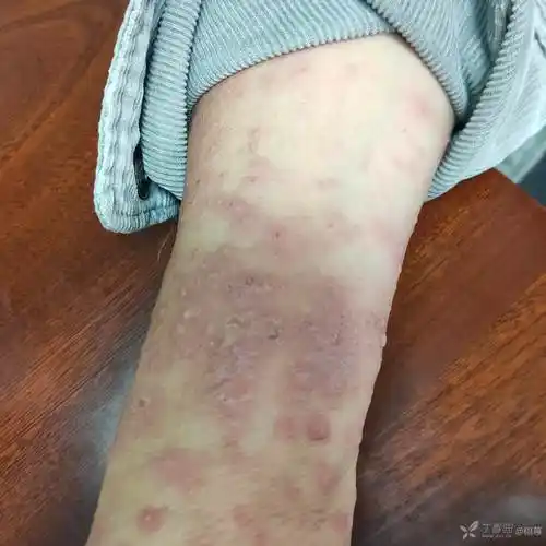 自身敏感性湿疹一例