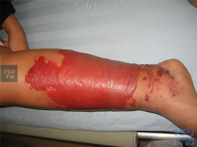 丹毒(erysipelas)症状表现