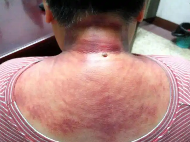 虎符铜砭刮痧对于颈椎病来说,安全易行,疗效显著.