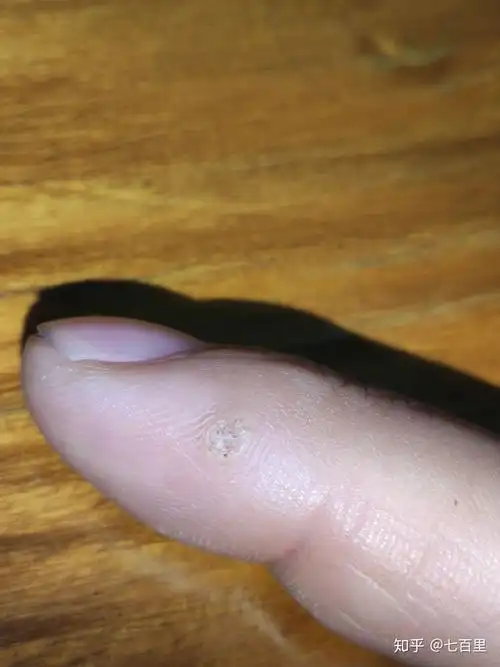 鸦胆子治刺猴的效果