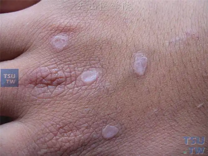 【附图】 扁平疣(verruca plana)症状表现 _皮肤病诊断图谱 | 天山