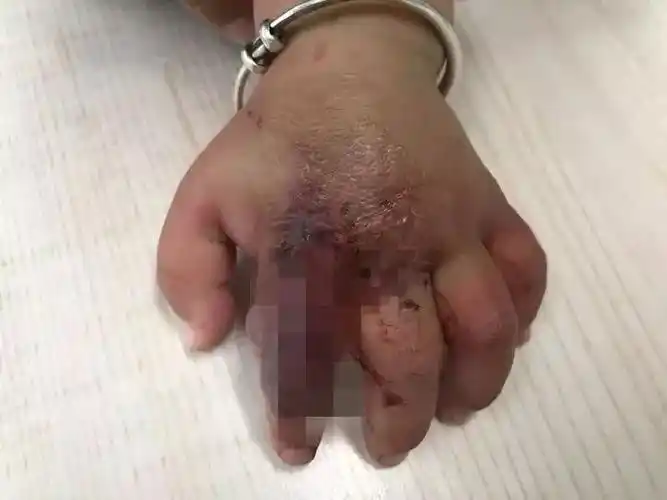 涂了奶奶自制的神仙水10个月宝宝手竟肿得像血馒头