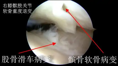 上下楼梯疼痛警惕髌骨软化症如何诊治