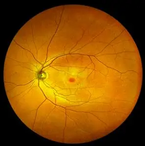 这是一张人体的正常眼底彩照(湘雅二医院眼科供图)