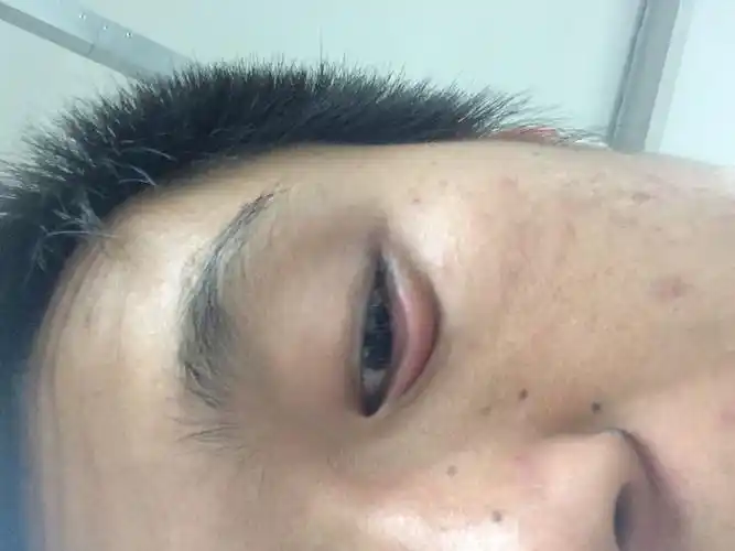 早上起来下眼睑肿大且有点疼中午服用了头孢呋辛酯片和加替沙