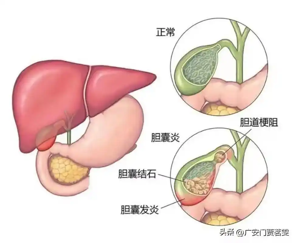 中医药可以把"胆结石"化掉吗?  胆囊炎,胆结石是临床常见疾病之一.