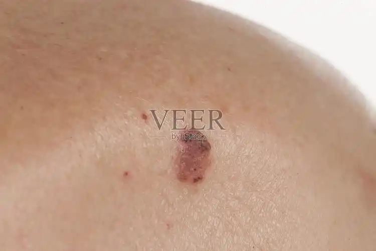 皮肤病学基皮细胞癌身体检查肿瘤学仅一个老年男人仔细检查角质层良性