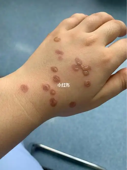 液氮冷冻治疗疼疼疼