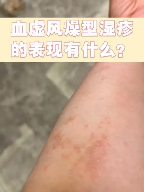 湿疹这种皮肤问题,看起来只是皮肤表面的问题,实际上与身体内在脏腑