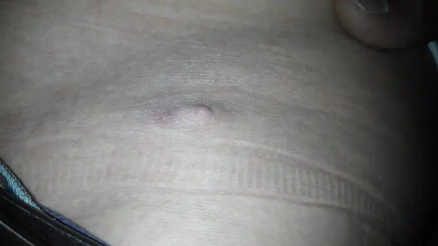 腰间长了个东西,不痛不痒,是怎么回事