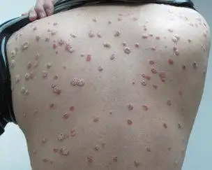 皮肤上有圆形斑块图片