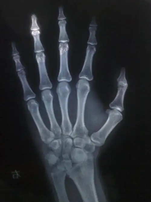 帮忙看下骨骺线闭合没,本人今年15岁,我还可以再长五公分吗