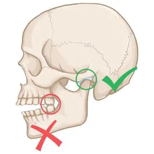 有颞下颌关节紊乱病该如何选择正畸医生