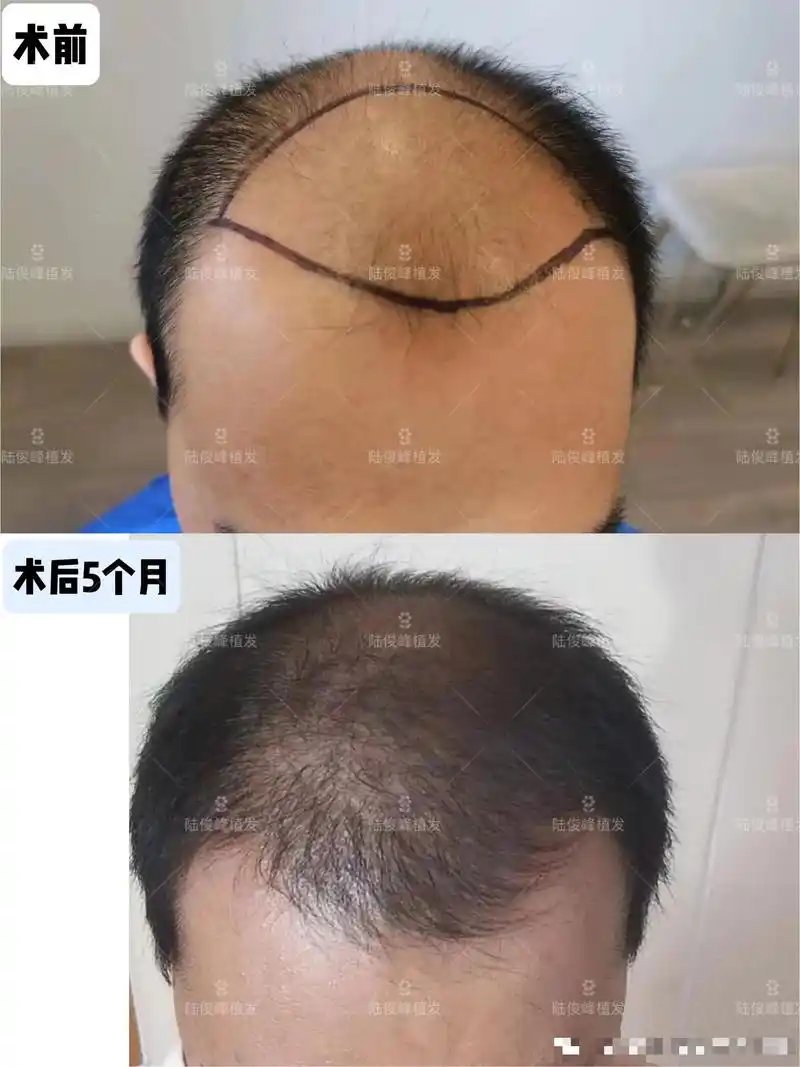【男士-前顶植发术后5个月】.这位患者术前头顶#脱发 严重, - 抖音
