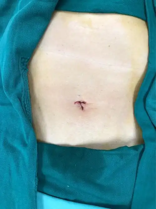 单孔腹腔镜胆囊切除术