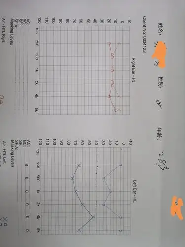 术前听力学检查, 纯音测试pta60db,a—b gap45db
