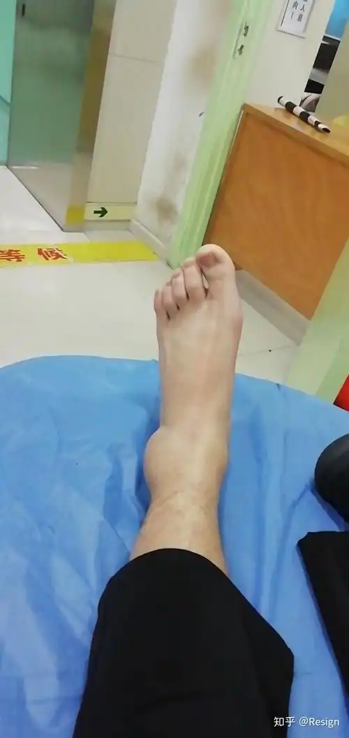 27号左外踝撕脱性骨折 - 知乎