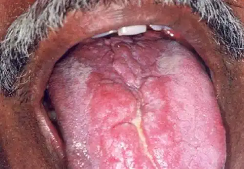 治疗舌炎的最好方法是什么