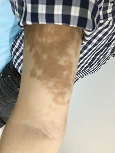 长毛又长斑-----色素毛表皮痣,becker痣的故事_痣_介绍_治疗方式 - 好