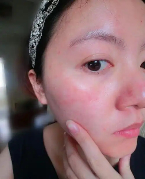 你又过敏了?让皮肤安全过圣诞,枫丹美业给你支招!