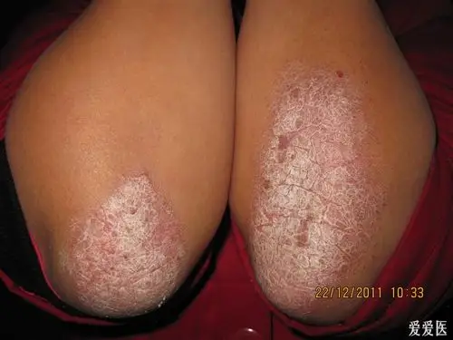 典型病例------------------------肘部银屑病(1)