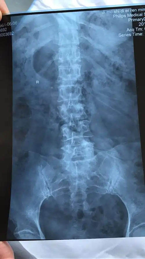 腰椎第三关节压缩性骨折,现在大夫让做微创手术,我想问问有没有必要?