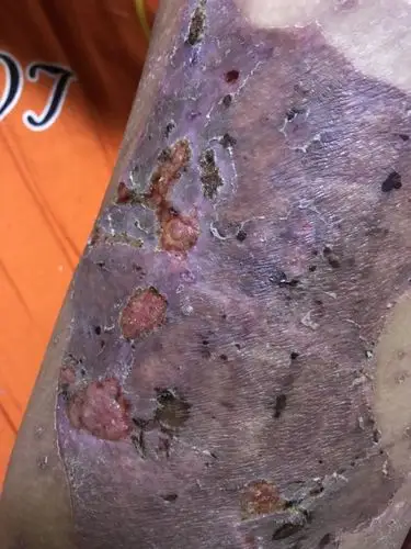 在大腿上取的皮,现在半个月了,取皮处还有几块地方没愈合,请问像这样