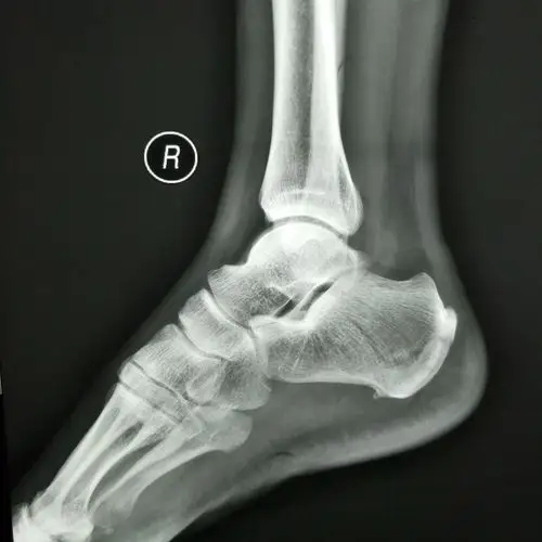 右跟骨侧位片(长度,高度尚可,盖世角120度左右,贝氏角存在)