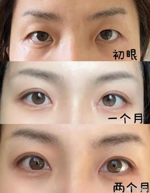 双眼皮前后对比(同事说完全两个人)