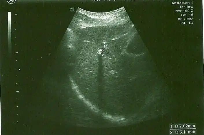 p>肝内钙化灶指在b超或 ct图像上肝脏内出现类似结石一样的强回声或