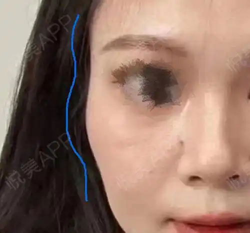 变美项目:自体脂肪填充太阳穴 额头-术前状态:额头扁平,太阳穴凹陷