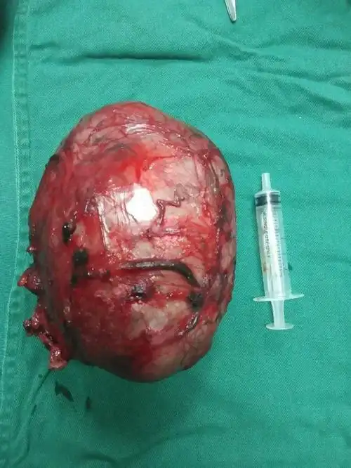 我院泌尿外科完成首例巨大睾丸肿瘤完整切除术