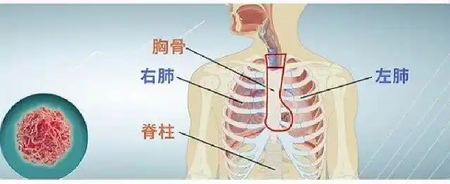 刺激性咳嗽,咯血,局限性哮鸣音,胸痛,胸骨后痛,肩痛,背痛