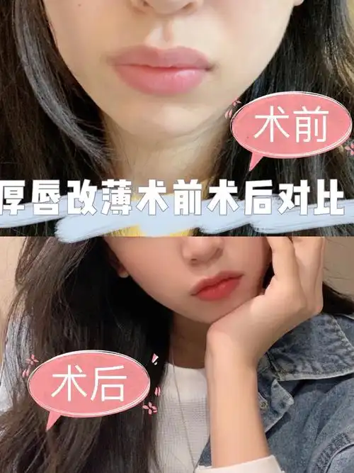 从今天起开始在新氧记录我的手术经历因为自己做之前想找案例参考