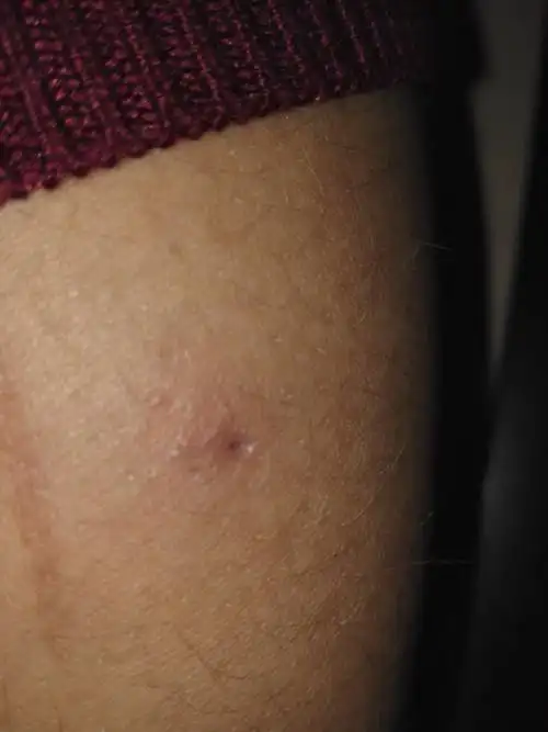 大约两天前手臂上长了这么一个疙瘩,四周很硬,还很痛,里面内陷的是