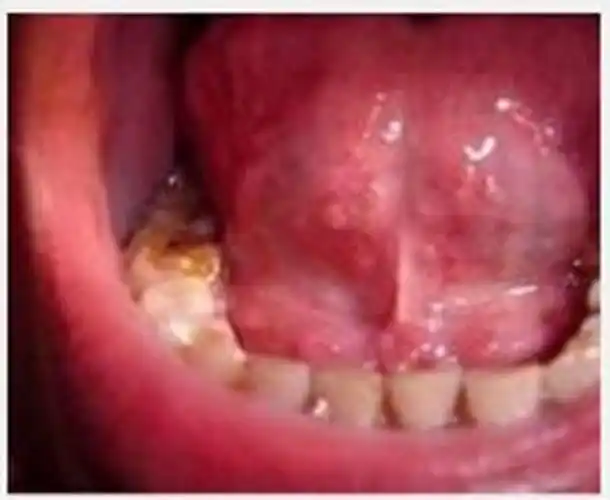 菜花状肛门尖锐湿疣图片