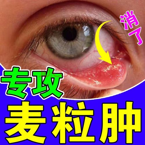 麦粒肿眼药水针眼眼睑炎睑板腺囊肿红肿脓包热痛眼痒流泪干涩堵塞沙眼