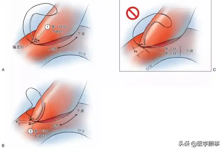 脑血管缝合技巧上