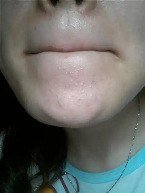 下巴长了闭口粉刺是什么原因