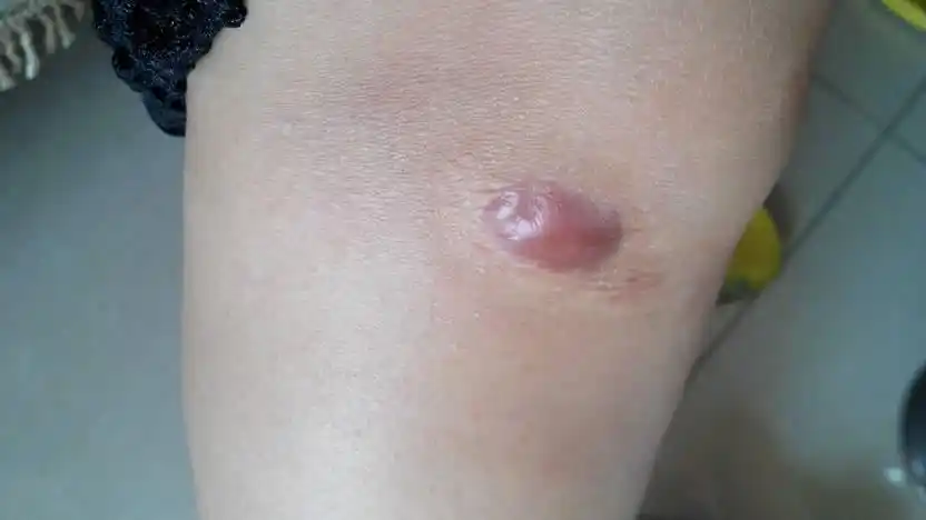 膝盖去年摔了,好了却留下了这个东西,这该怎么去掉