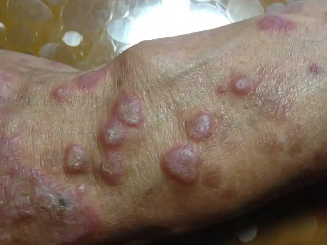 今天碰到的扁平苔藓 - 皮肤及性传播疾病讨论版 - 爱爱医医学论坛