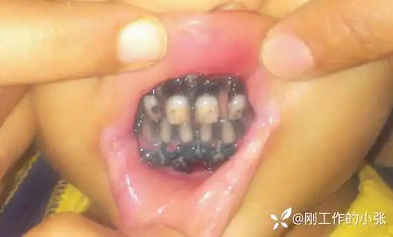 世界惊奇病例发烧20天3岁男孩牙龈全变黑怎么回事