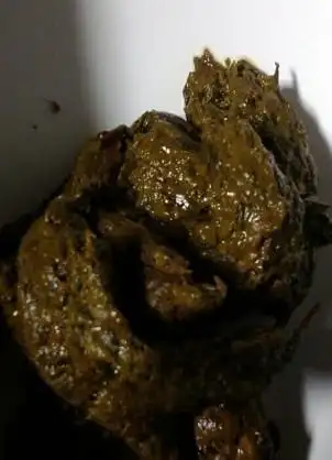 这颜色的,不是想恶心各位,求解答,是胃的问题吗 最佳答案 本回答由