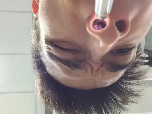 请问我这个是不是鼻窦粘膜肿大?