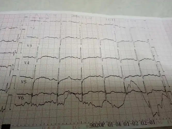 女52岁体检发现心肌供血不足附心电图如何调理
