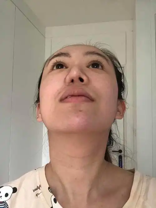 小姑娘之前在外院做了46615次隆鼻,导致鼻孔一大一小_圈子-新氧