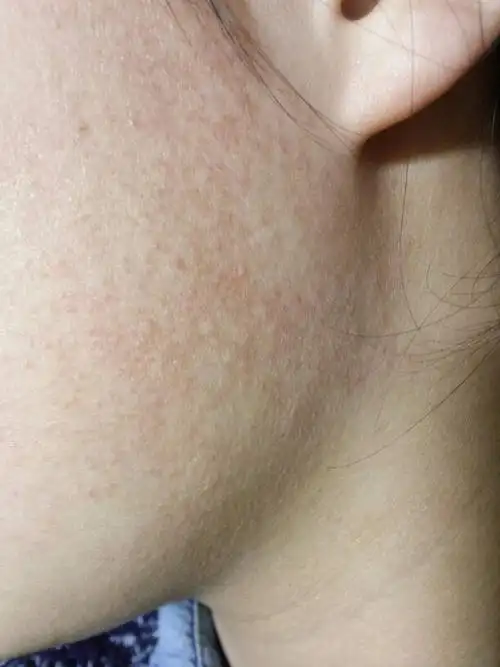 不知道从什么时候开始这样的,只有两边脸颊一小块皮肤这样,不痛不痒摸