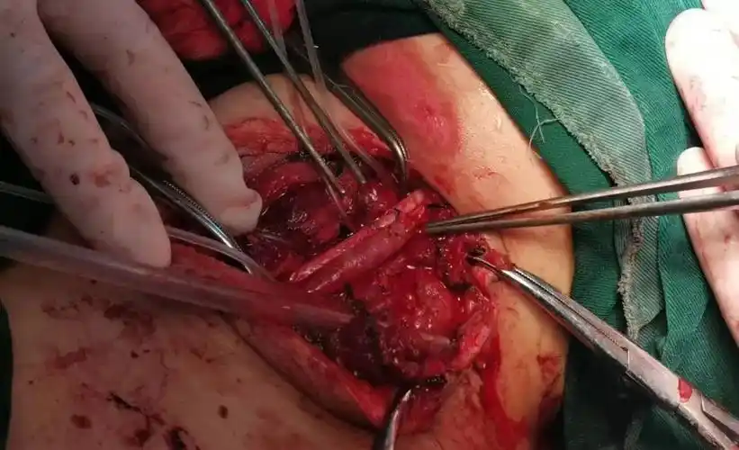 丰医人,与生命同行――县医院成功抢救一例颈总动脉断裂大出血患者