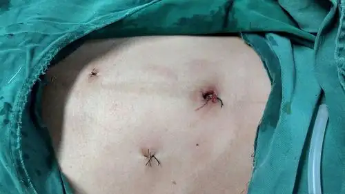 桐柏县人民医院,普外科,很常见手术之一:经腹腔镜(微创)阑尾切除术.